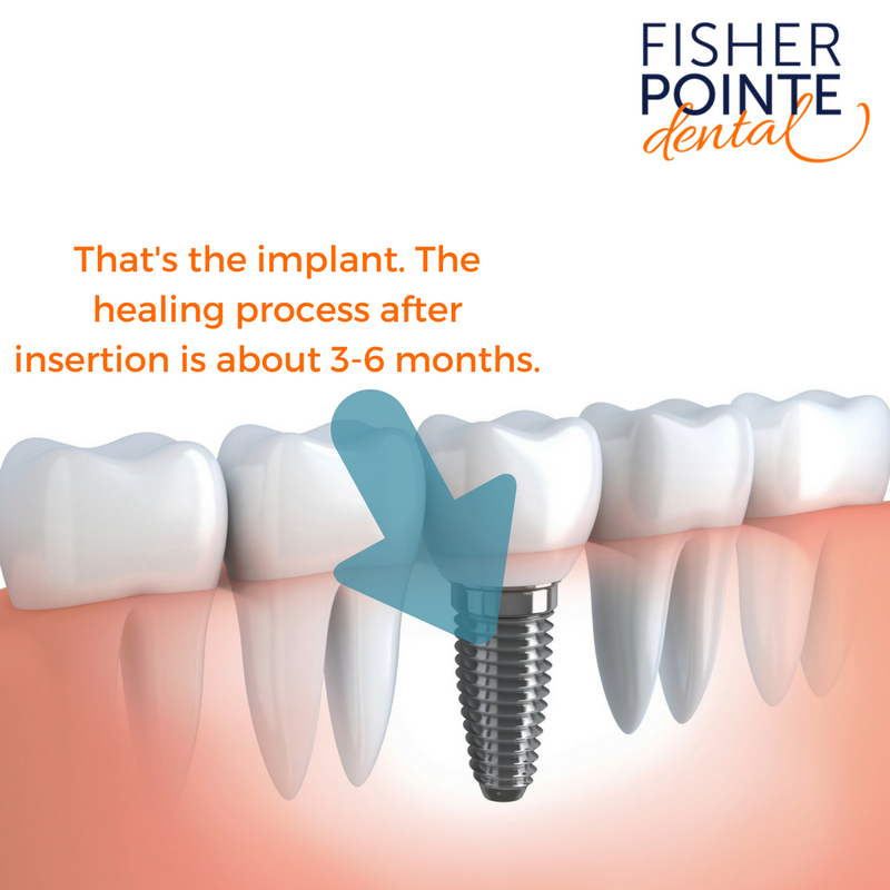 The healing process after insertion of a dental implant is about 3 to 6 months. This image is a graphic showing the implant under the gums, along with the prosthetic tooth on the implant.