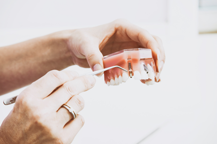Is a dental bridge or implant better for you? Deciding on the right dental procedure depends on a variety of factors.