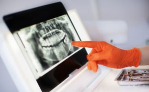Are Dental X-Rays Dangerous
