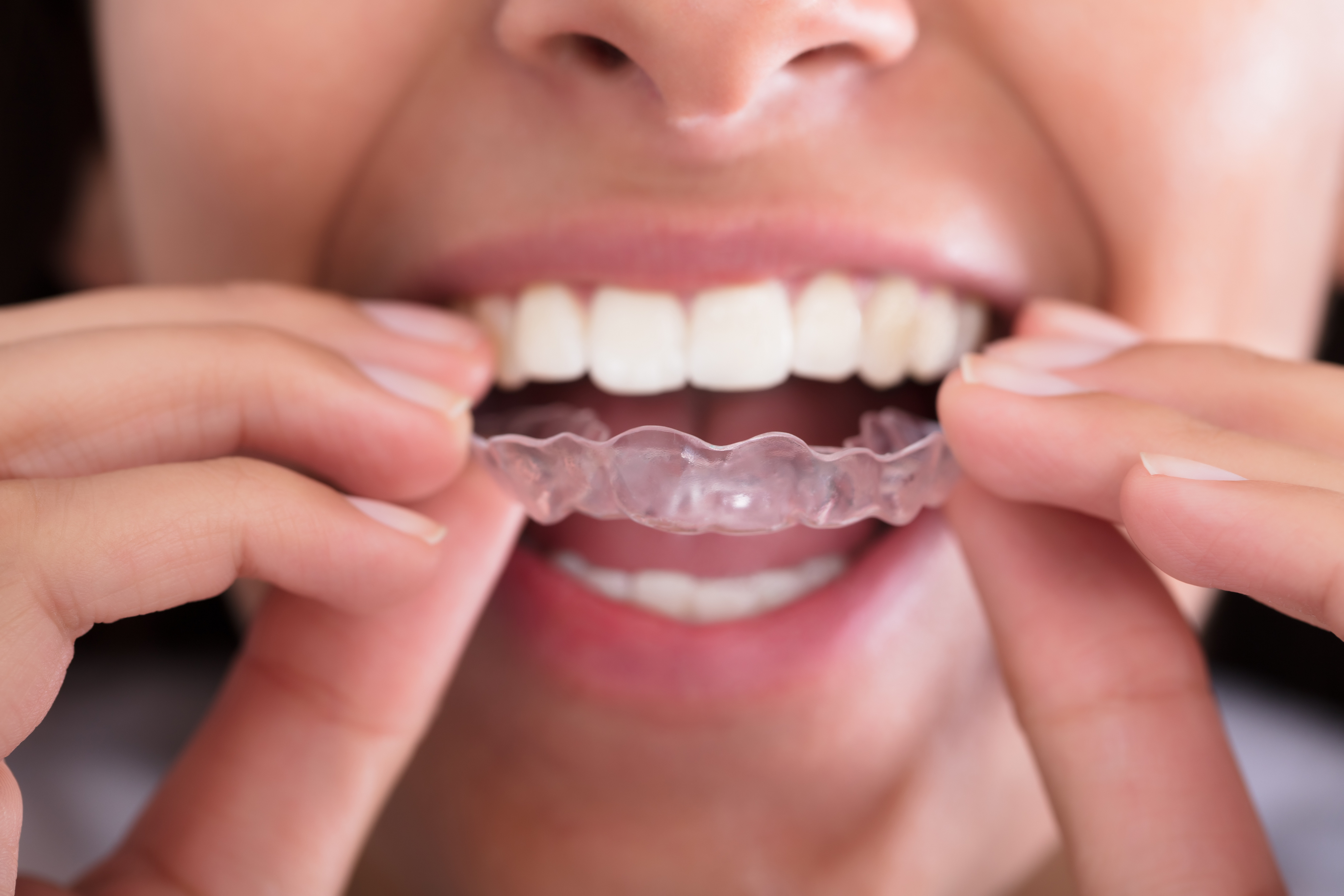 Schedule an appointment with our dentist in Grosse Pointe to learn more about how Invisalign works.