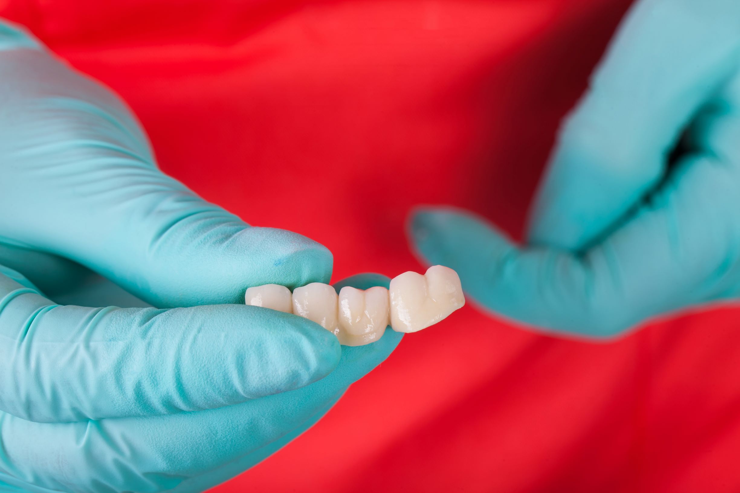 Living with a dental bridge is like living with your other teeth. A bridge consists of a row of crowns with a pontic and covers for abutment teeth.