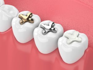 The main type of dental filling material we use is composite resin due to its durability, aesthetic qualities, and affordability.