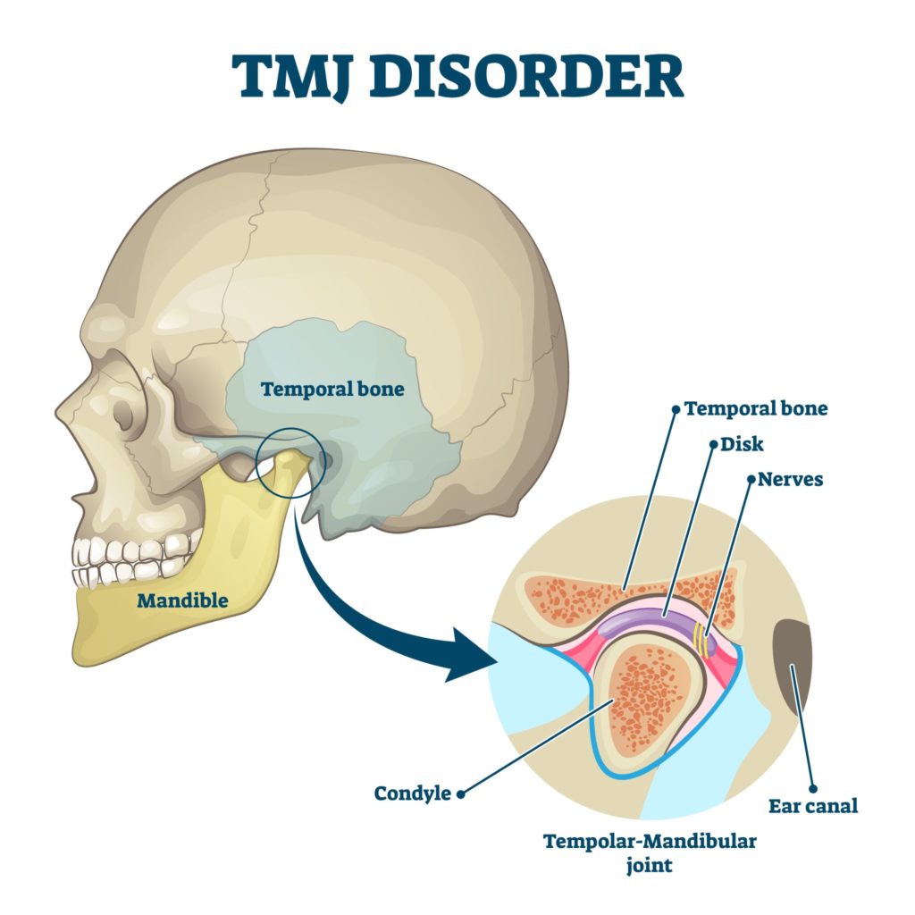 This diagram identifies the various parts of the tempomandibular joint to represent TMJ disorder.