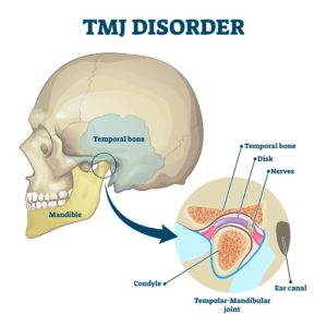This diagram identifies the various parts of the temporomandibular joint to represent TMJ disorder.