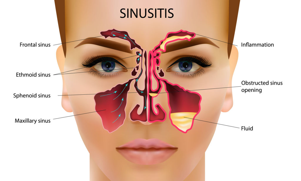 As shown in this diagram, a sinus infection is known as sinusitis.