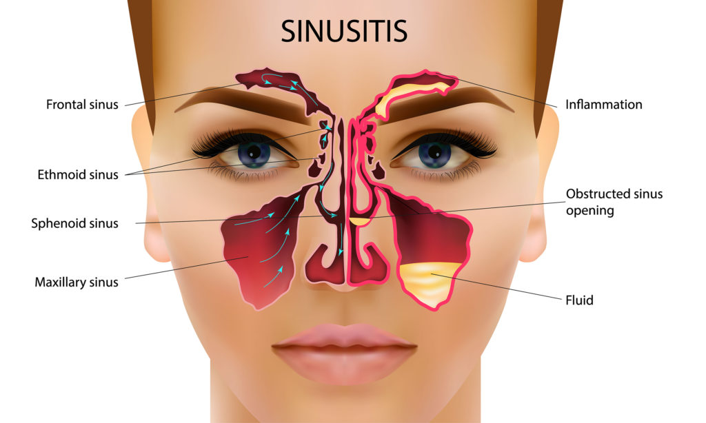 sinus canal infection