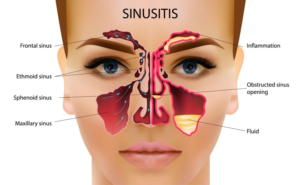 Your Sinuses And Oral Health Connection Grosse Pointe Dentist Your Sinuses And Oral Health Connection Grosse Pointe Dentist