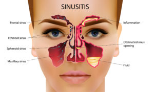 As shown in this diagram, an infection of the sinuses is known as sinusitis.