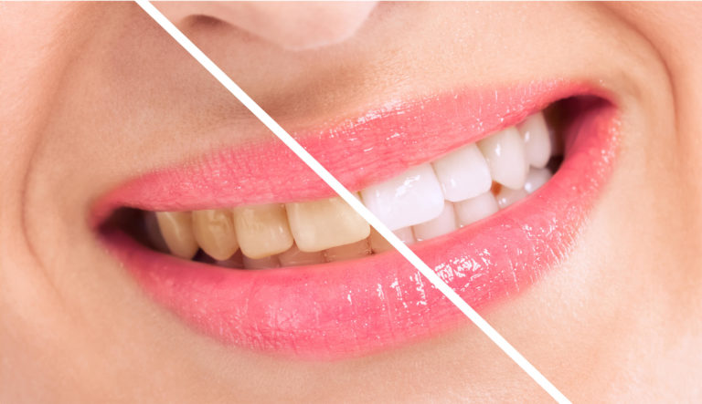Yellow to white teeth before and after